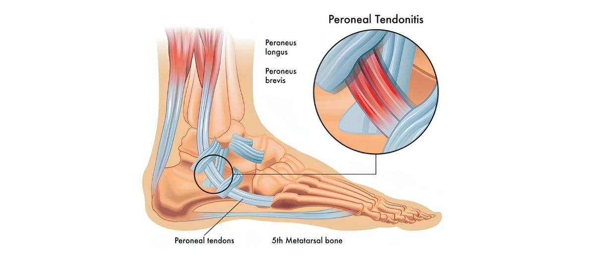 Insertional Peroneus Brevis Tendonitis